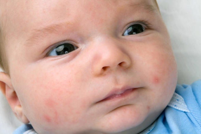 dermatitis in infants