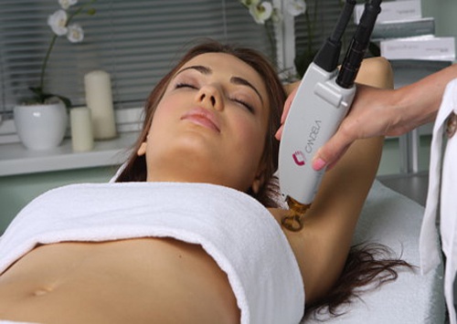 What you need to know about laser hair removal