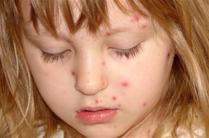 How is measles transmitted?