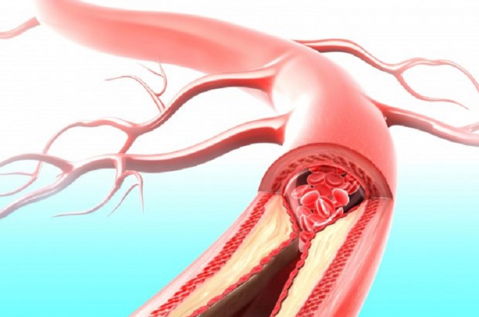 Atherosclerosis: symptoms, diagnosis, treatment and prevention