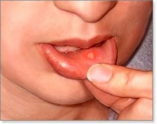 Tip 1: What is stomatitis