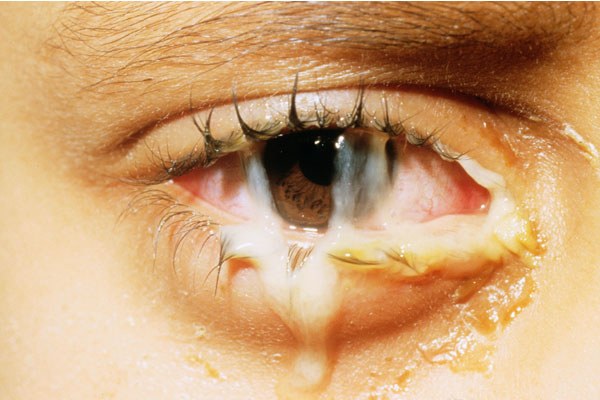 Tip 1: Conjunctivitis: Symptoms and Treatment